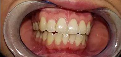 Teeth Whitening before at Signature Smiles Dentistry of Plano in Plano, TX