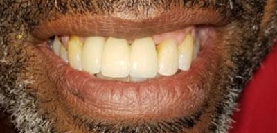 Signature Smiles Dentistry of Plano dental implants after — Plano, TX