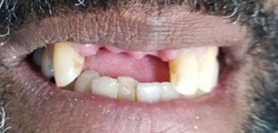Dental Implants before at Signature Smiles Dentistry of Plano in Plano, TX