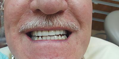 Signature Smiles Dentistry of Plano veneers after — Plano, TX