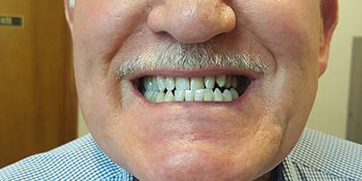 Dental Veneers before at Signature Smiles Dentistry of Plano in Plano, TX