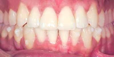 Signature Smiles Dentistry of Plano invisalign after — Plano, TX