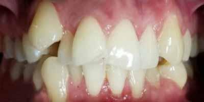 Invisalign before at Signature Smiles Dentistry of Plano in Plano, TX