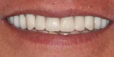 Signature Smiles Dentistry of Plano dental implants after — Plano, TX