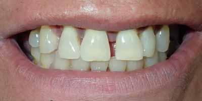 Dental Implants before at Signature Smiles Dentistry of Plano in Plano, TX