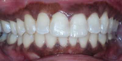 Signature Smiles Dentistry of Plano invisalign after — Plano, TX