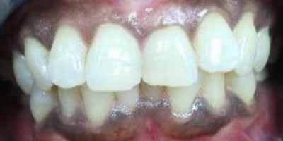 Invisalign before at Signature Smiles Dentistry of Plano in Plano, TX
