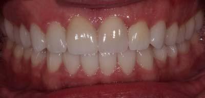 Signature Smiles Dentistry of Plano veneers after — Plano, TX