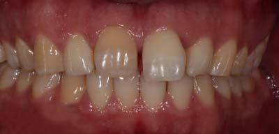 Dental Veneers before at Signature Smiles Dentistry of Plano in Plano, TX