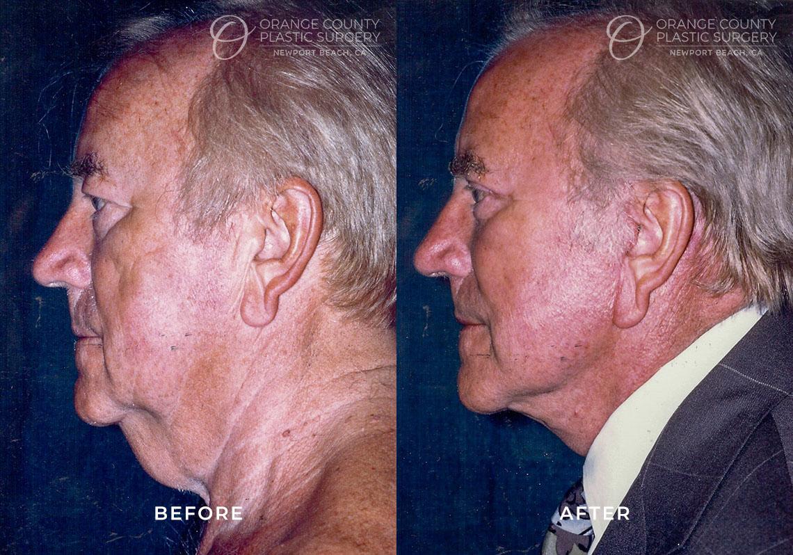 Juris Bunkis, MD facelift result — Newport Beach, CA