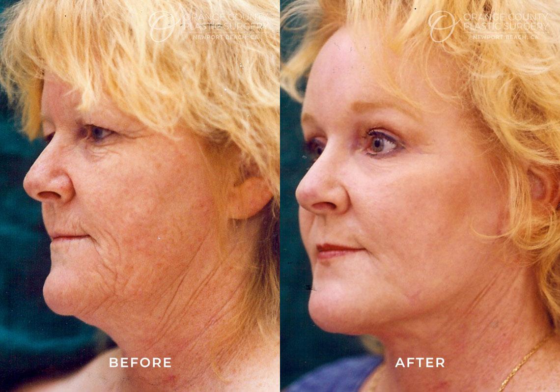 Juris Bunkis, MD result — Newport Beach, CA