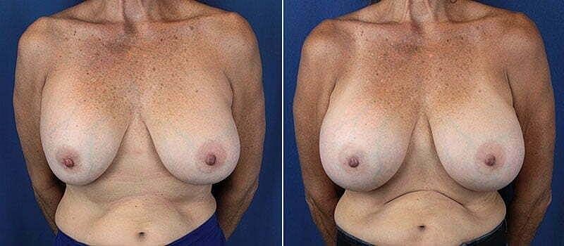 Beauty by Buford (Gregory A. Buford, MD) breast augmentation revision result — Lone Tree, CO