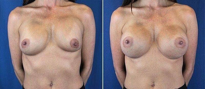 Beauty by Buford (Gregory A. Buford, MD) breast augmentation revision result — Lone Tree, CO