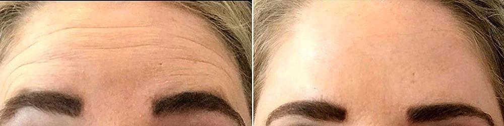 Beauty by Buford (Gregory A. Buford, MD) botox result — Lone Tree, CO