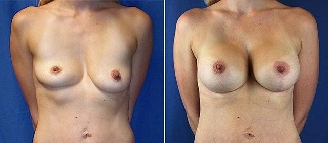Breast Lift result at Beauty by Buford (Gregory A. Buford, MD) in Lone Tree, CO