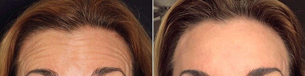 Beauty by Buford (Gregory A. Buford, MD) botox result — Lone Tree, CO
