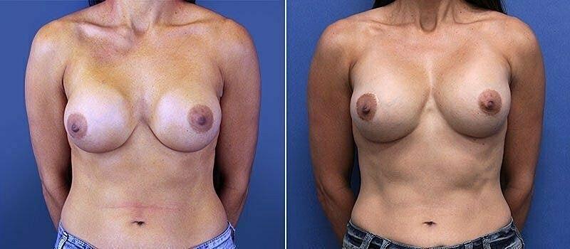 Beauty by Buford (Gregory A. Buford, MD) breast augmentation revision result — Lone Tree, CO