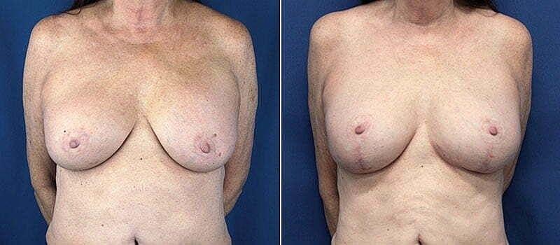 Beauty by Buford (Gregory A. Buford, MD) breast augmentation revision result — Lone Tree, CO