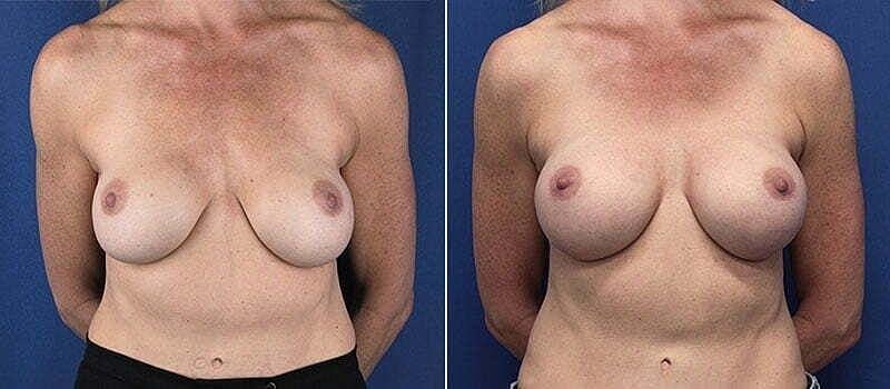 Beauty by Buford (Gregory A. Buford, MD) breast augmentation revision result — Lone Tree, CO