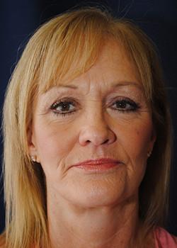 Watterson Plastic Surgery facelift after — Draper, UT