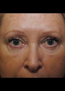 Blepharoplasty after at Watterson Plastic Surgery in Draper, UT