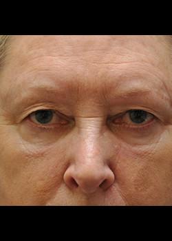 Blepharoplasty before at Watterson Plastic Surgery in Draper, UT