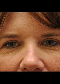 Watterson Plastic Surgery blepharoplasty after — Draper, UT