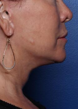 Facelift after at Watterson Plastic Surgery in Draper, UT