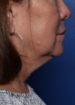 Facelift before at Watterson Plastic Surgery in Draper, UT