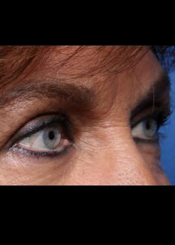 Watterson Plastic Surgery blepharoplasty after — Draper, UT