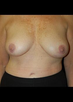 Watterson Plastic Surgery breast lift after — Draper, UT