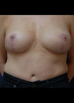 Breast Lift before at Watterson Plastic Surgery in Draper, UT