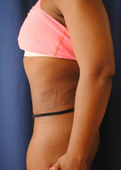 Mini Tummy Tuck after at Watterson Plastic Surgery in Draper, UT
