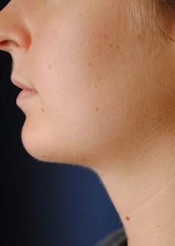 Neck Liposuction after at Watterson Plastic Surgery in Draper, UT
