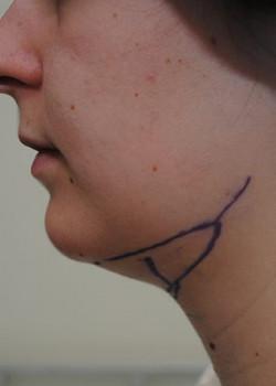 Neck Liposuction before at Watterson Plastic Surgery in Draper, UT