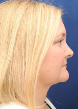 Neck Liposuction after at Watterson Plastic Surgery in Draper, UT