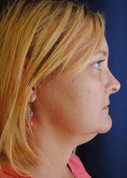 Neck Liposuction before at Watterson Plastic Surgery in Draper, UT