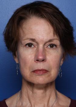 Neck Lift before at Watterson Plastic Surgery in Draper, UT