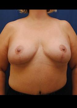 Watterson Plastic Surgery breast reduction after — Draper, UT