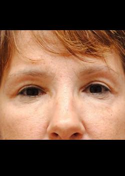 Watterson Plastic Surgery blepharoplasty after — Draper, UT
