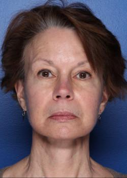 Neck Lift after at Watterson Plastic Surgery in Draper, UT