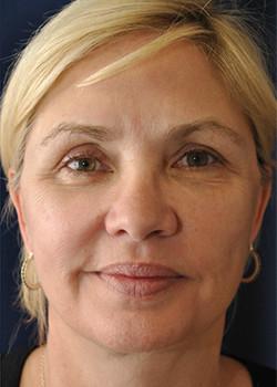 Watterson Plastic Surgery facelift after — Draper, UT