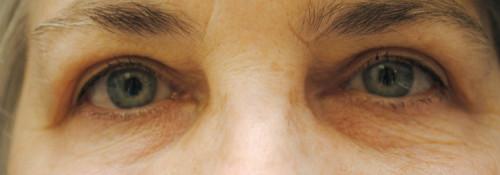 Watterson Plastic Surgery blepharoplasty after — Draper, UT