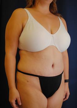 Tummy Tuck after at Watterson Plastic Surgery in Draper, UT