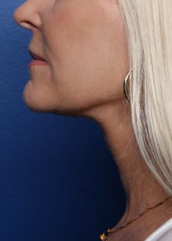 Neck Lift after at Watterson Plastic Surgery in Draper, UT