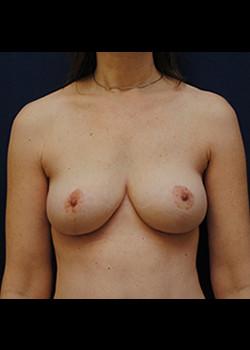 Watterson Plastic Surgery breast lift after — Draper, UT