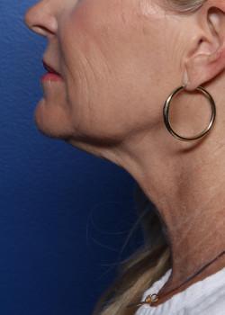 Neck Lift before at Watterson Plastic Surgery in Draper, UT