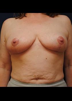 Breast Reduction after at Watterson Plastic Surgery in Draper, UT