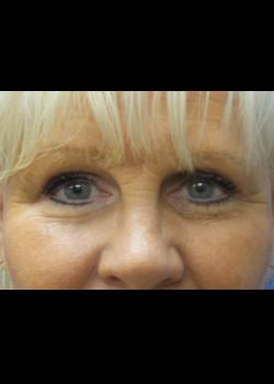 Blepharoplasty after at Watterson Plastic Surgery in Draper, UT