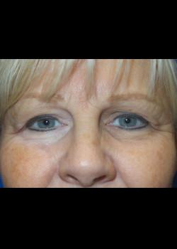 Blepharoplasty before at Watterson Plastic Surgery in Draper, UT
